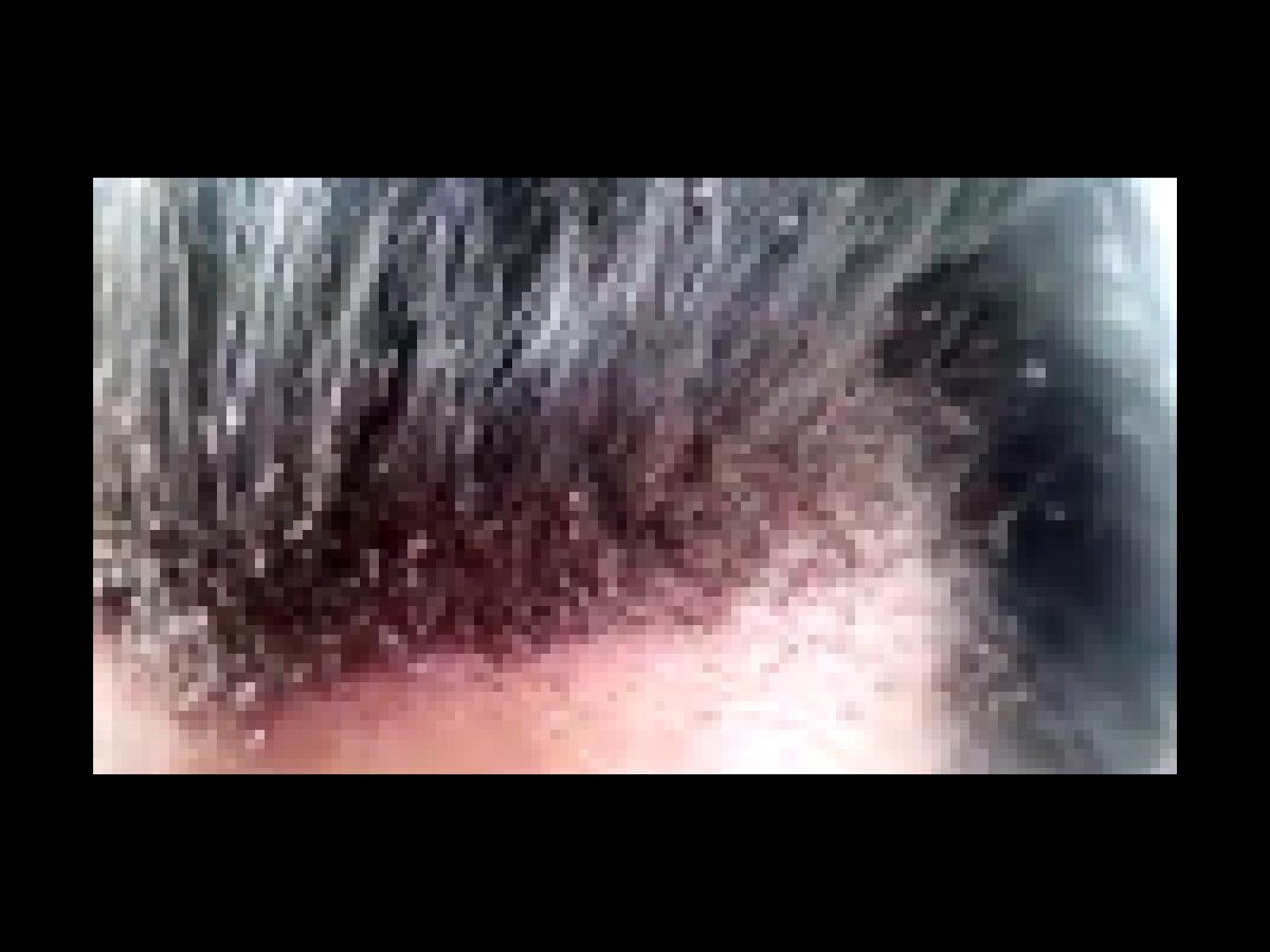 This viral video has to be the worst case of head lice you will ever