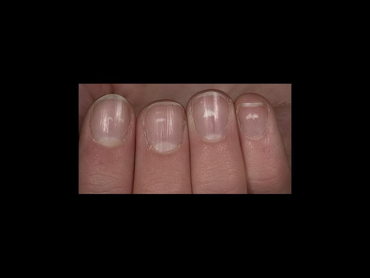 What Do White Fingernails Mean