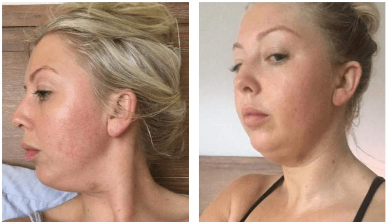 fat chin injections liposuction injection lose double shot