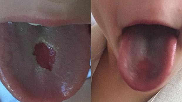 Favourite kids' lolly burns through boy's tongue | Nova 969