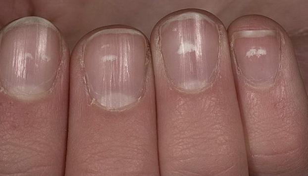 What Do The White Lines On Fingernails Mean