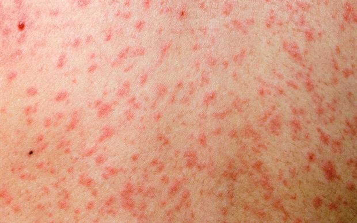 Health alert issued after man infectious with measles attends MCG | Nova 1001240 x 776